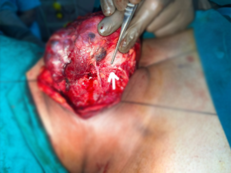 Thyroid Surgery